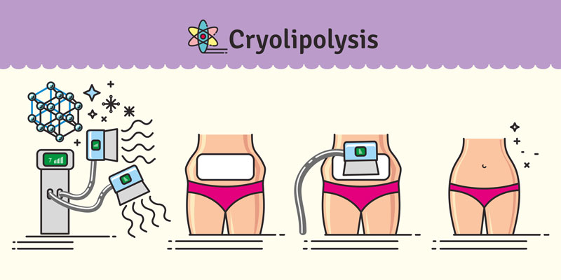 cryolipolysis infographic