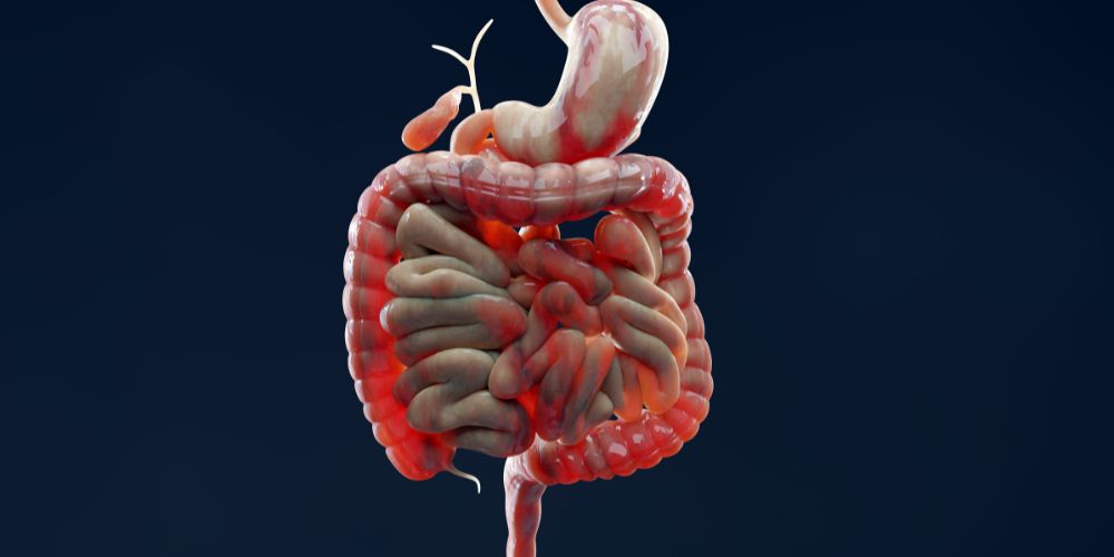 Irritable Bowel Syndrome 1