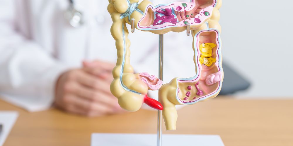 Irritable bowel syndrome Symptoms