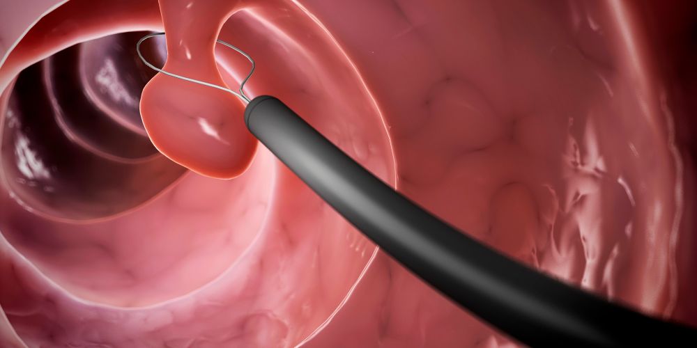 Removal-polyp.jpg