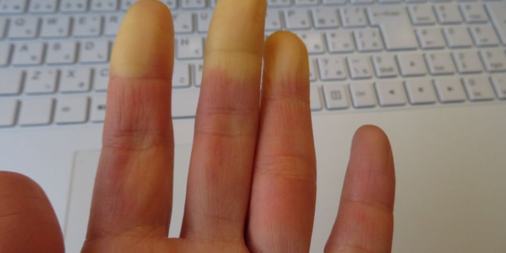 Scleroderma.jpg