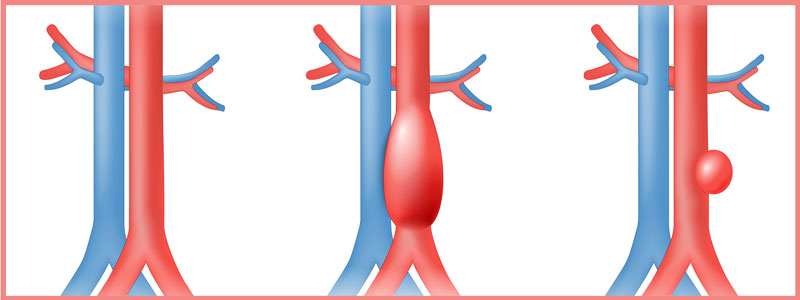 aneyrusma aortis 01