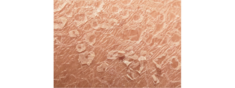 apolepisi