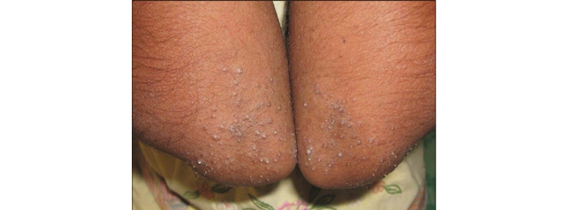 frinoderma