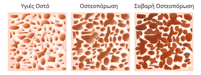 osteoporosi stadia inside