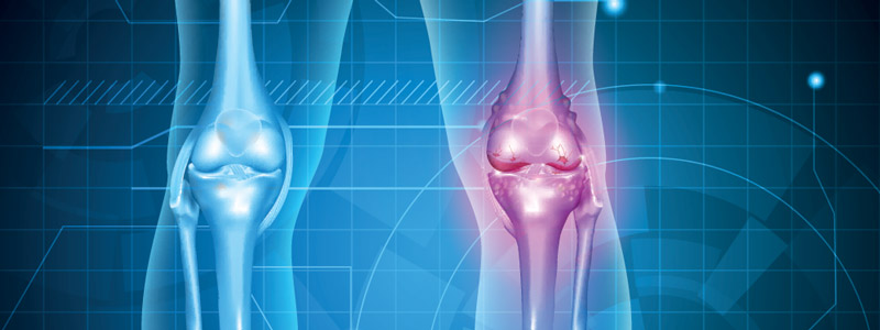 osteoathritida