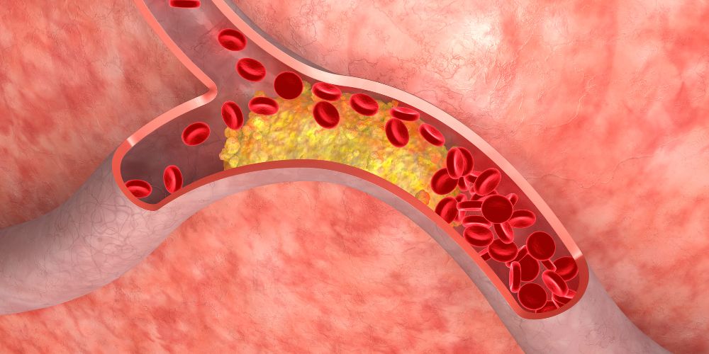 cholesterol vessels