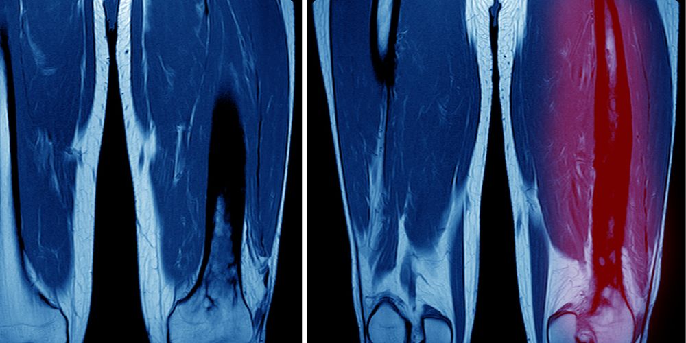 osteomyelitis