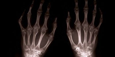 Rheumatoid Arthritis