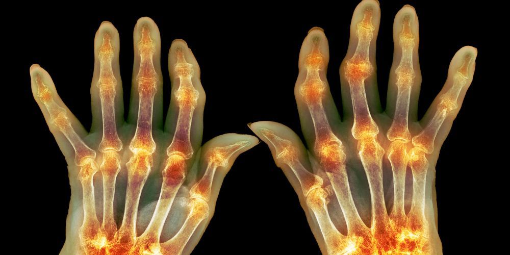 ofeli tis kourkouminis sti revmatoeidi arthritida