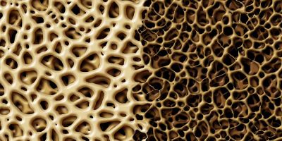 &Omicron;&sigma;&tau;&epsilon;&omicron;&pi;ό&rho;&omega;&sigma;&eta;