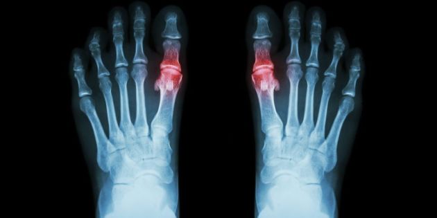 revmatoeidis-arthritida-poios-o-rolos-tis-vitaminis-d-stin-prolipsi-tis-nosou
