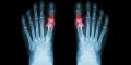 revmatoeidis-arthritida-poios-o-rolos-tis-vitaminis-d-stin-prolipsi-tis-nosou